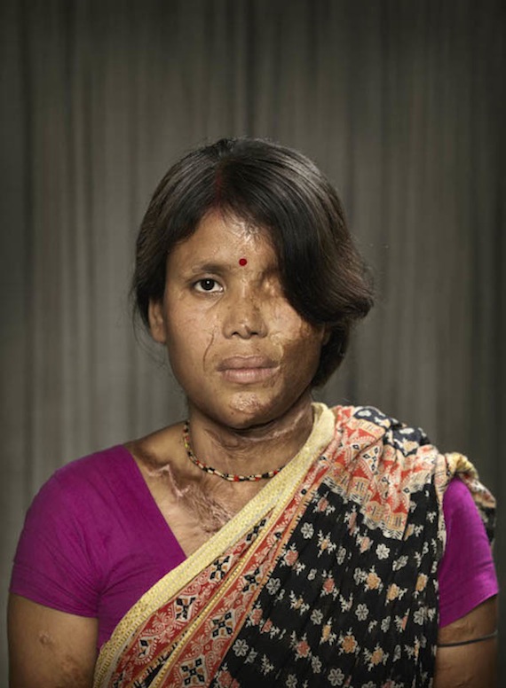 Ken Hermann y Tai Klan decidieron mostrar las consecuencias de los ataques con ácido en este proyecto. Foto: Ken Hermann