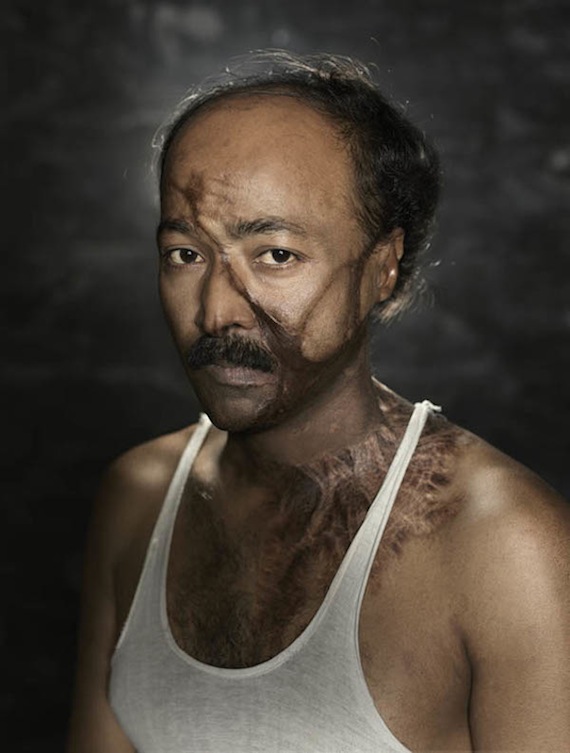 Los ataques con ácido son una práctica recurrente en el sur y sureste asiático. Foto: Ken Hermann