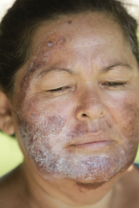  Luz Mercedes Acosta, habitante de la zona, quien fue afectada al lavarse la cara con agua del río Sonora sin saber que estaba contaminada con ácidos y metales pesados. Foto: Cuartoscuro