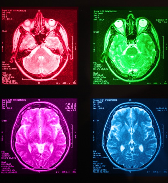 Los investigadores examinaron con tomografías la relación entre los problemas del sueño como el insomnio y el volumen del cerebro. Foto: Shutterstock