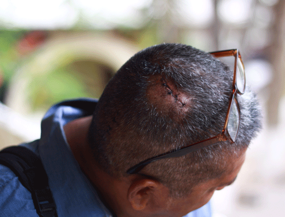 Uno de los agredidos por la Policía Federal en los enfrentamientos de Chilpancingo. Foto: Antonio Cruz, SinEmbargo