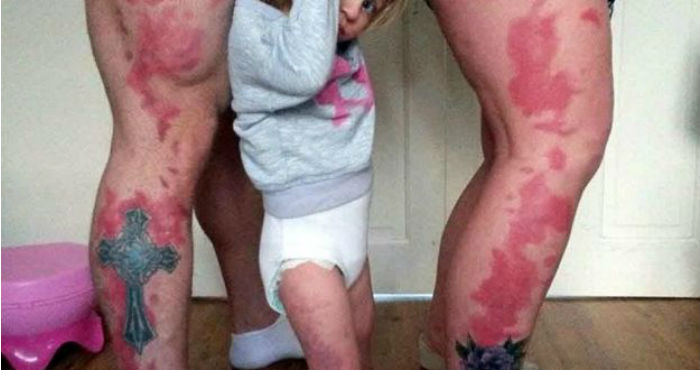 El hemangioma es una lesión rojiza que está constituida por vasos sanguíneos de pequeño tamaño en forma agrupada