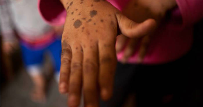 Axia de 8 años muestra sus manchas en la piel. Las Madres Cuidadoras de la Cultura Qom, de Pampa del Indio, en la provincia argentina de Chaco, llevan 20 años luchando por recuperar y difundir su cultura a través de iniciativas que han logrado resucitar danzas y leyendas tradicionales de su pueblo. Foto: EFE