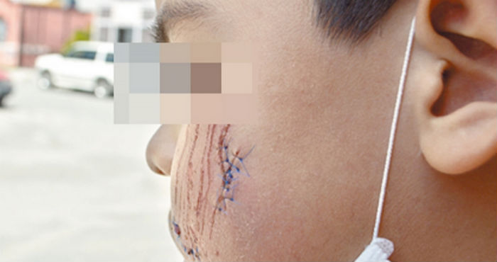 La propietaria salió, recogió el globo y al entregárselo a Pedro, el perro saltó logrando clavar los colmillos en la mejilla del niño. Foto: Vanguardia