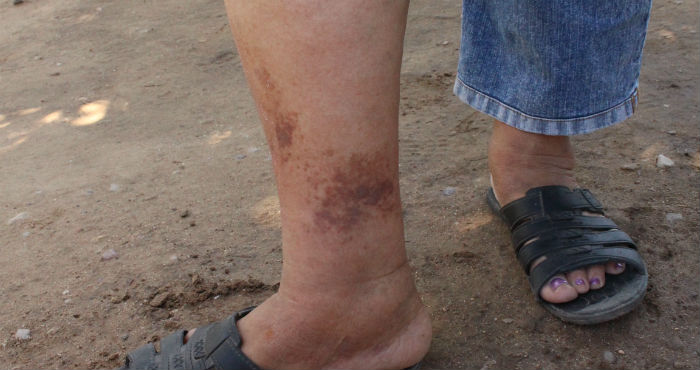 Afectaciones en la piel sufridas por algunos habitantes de la zona cercana a la presa contaminada. Fotos: Olivia Paredes, especial para SinEmbargo