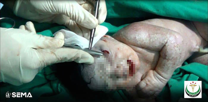 bebé sirio Doctores extirpan esquirlas a bebé sirio. Foto: Facebook