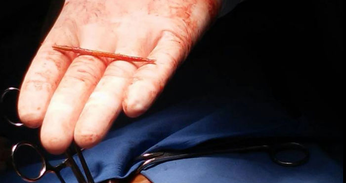 Un palillo que estaba enterrado en el corazón de un hombre argentino. Foto: El Clarín
