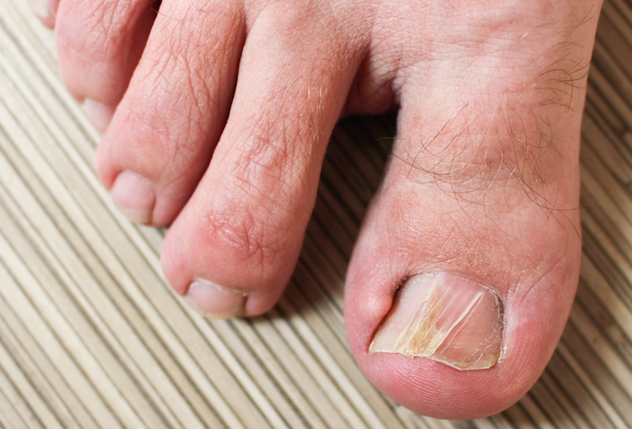 Los zapatos y los machucones perjudican las uñas de las pies. Foto: Shutterstock
