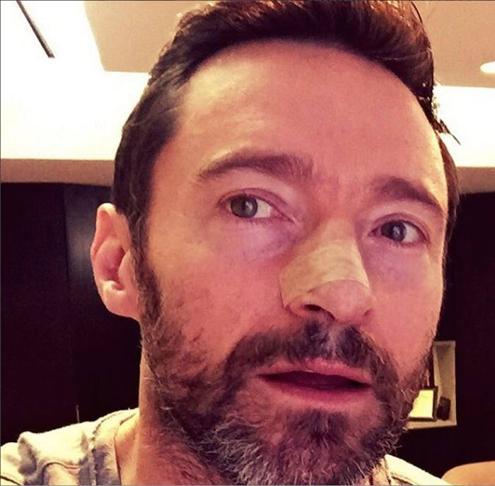 Hugh Jackman es operado por quinta vez. Foto: Instagram Jackman