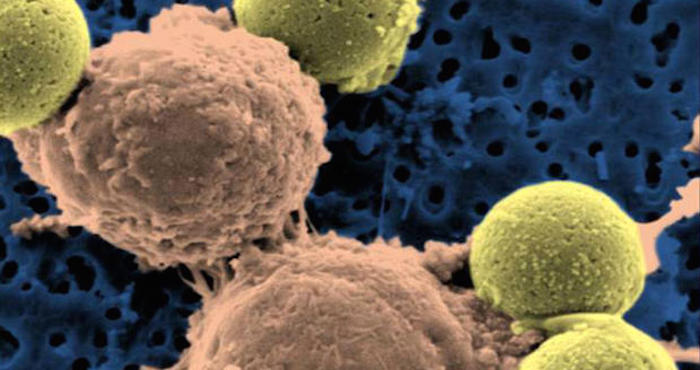 Al menos un tercio de todos los casos de cáncer pueden prevenirse, según la OMS. Foto: AP