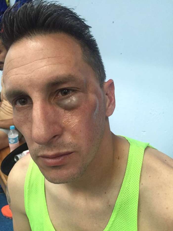 El Chaco sufre fractura de pómulo. Foto: @Cruz_Azul_FC