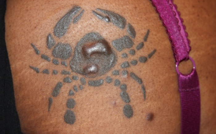 Algunos melanomas pueden pasar desapercibidos. Foto: Dr. Michael H. Tirgan