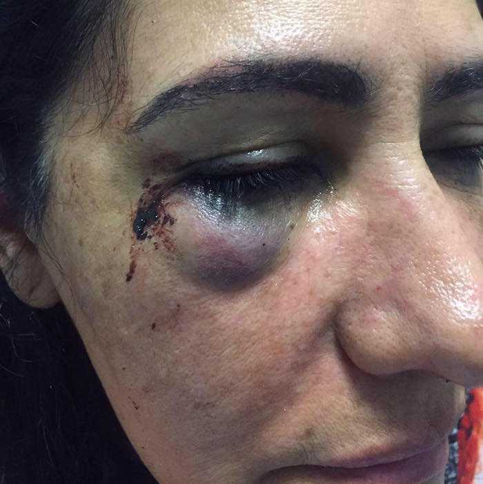 La denuncia fue acompañada con fotos en las que la agredida aparece con collarín y contusiones. Foto: Facebook/ Adolfo Micalco Mendez