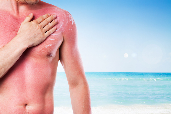 Los expertos también recomiendan evitar salones para broncearse porque se ha relacionado las camas bronceadoras con el aumento de melanoma. Foto Shutterstock