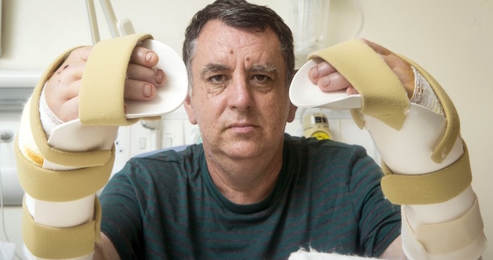 Chris King, la primera persona en Gran Bretaña en recibir un doble trasplante de manos, las muestra en el Hospital General de Leeds, en esta ciudad de Inglaterra, el jueves 21 de julio de 2016. King dijo el viernes que se siente "completo de nuevo" después de la cirugía. El hombre de 57 años perdió las dos manos, excepto los pulgares, en un accidente industrial hace tres años. Foto: AP