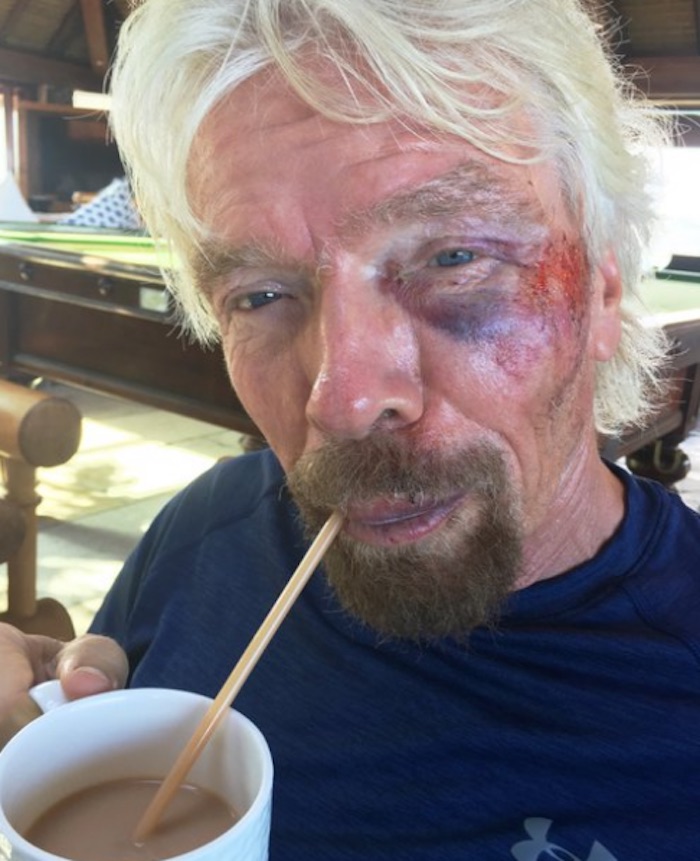 El magnate también compartió fotografías de su estado y aseguró que se considera un hombre afortunado por seguir con vida, a pesar de las heridas. Foto: Twitter vía @richardbranson
