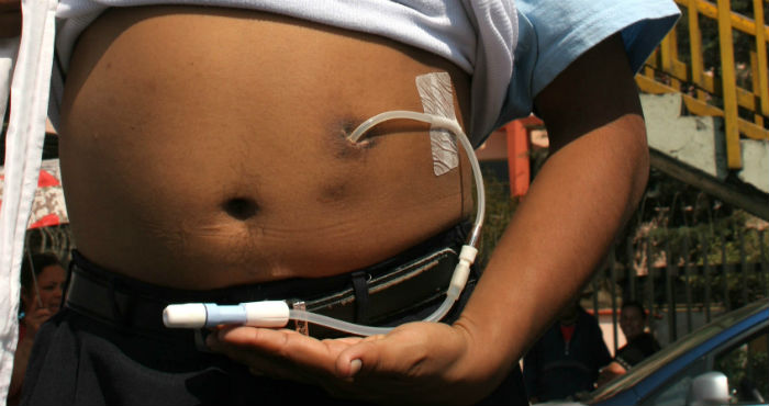 Un paciente con diálisis. Foto: Cuartoscuro