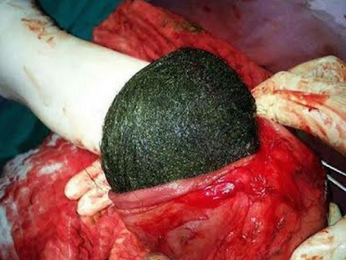 La mujer se quitaba y comía su propio cabello. Foto: BMJ Journals.