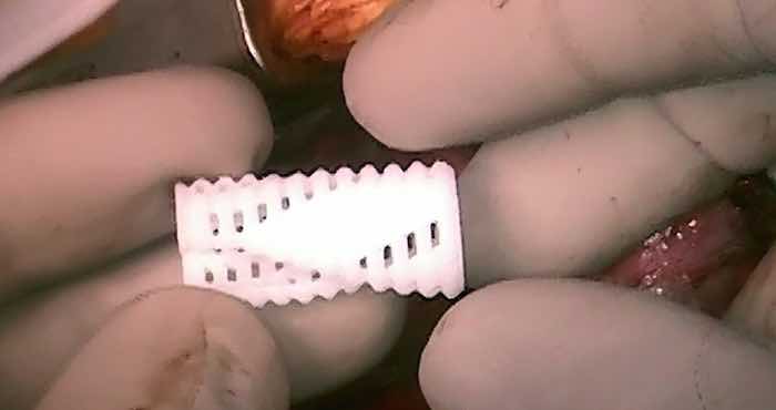 En la imagen, una de las "férulas traqueobronquiales” implantada a uno de los infantes. Foto: Dr. Robert Morrison et al., Science Translational Medicine (2015).