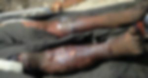 Lino "O" dormía en un lote baldío cuando unos hombres lo golpearon, rociaron de gasolina y le prendieron fuego. Foto: Plumas Libres.