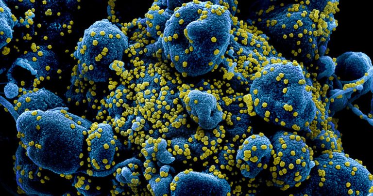 Una célula humana rodeada por SARS-CoV-2. Imagen coloreada.
