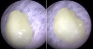 El doctor utilizó un instrumento de succión para retirar el objeto, que le provocó una inflamación al pequeño paciente. Foto: Captura de video