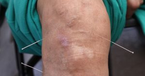 Desde siempre hemos escuchado a nuestros mayores –y quizás ahora a nosotros mismos– relacionar el dolor de huesos o articulaciones con los cambios meteorológicos. Foto: Moisés Pablo, Cuartoscuro