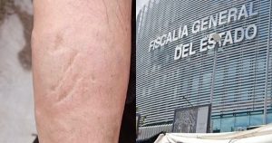 Mujer es atacada con ácido en Puebla por hombres; tiene quemadura de segundo grado