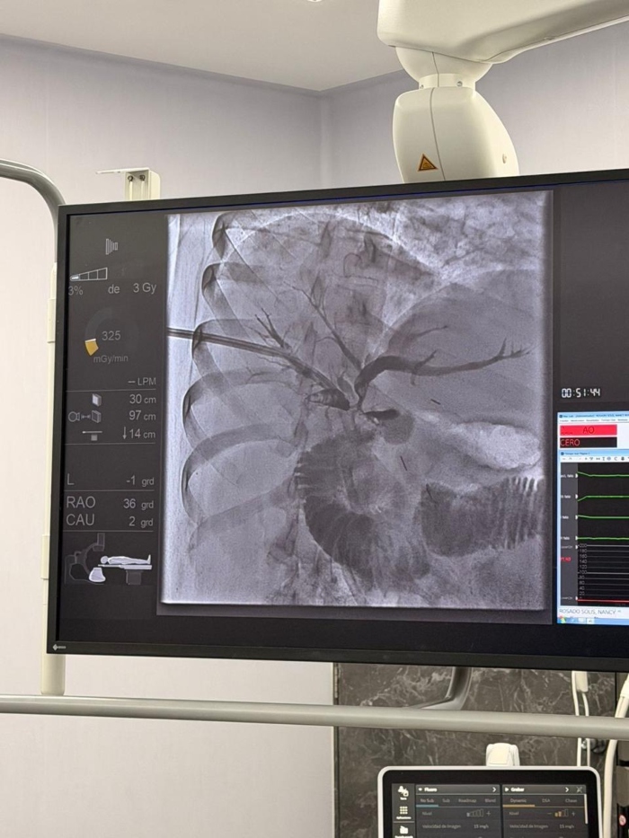 El ISSSTE realizó el primer procedimiento directo en vías biliares en el Hospital Regional de Mérida, Yucatán.