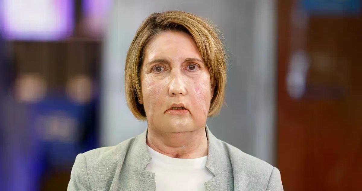 El Hospital Vall d'Hebron de Barcelona realizó “el primer trasplante de cara del mundo” con la donación de una persona que había recibido la eutanasia.